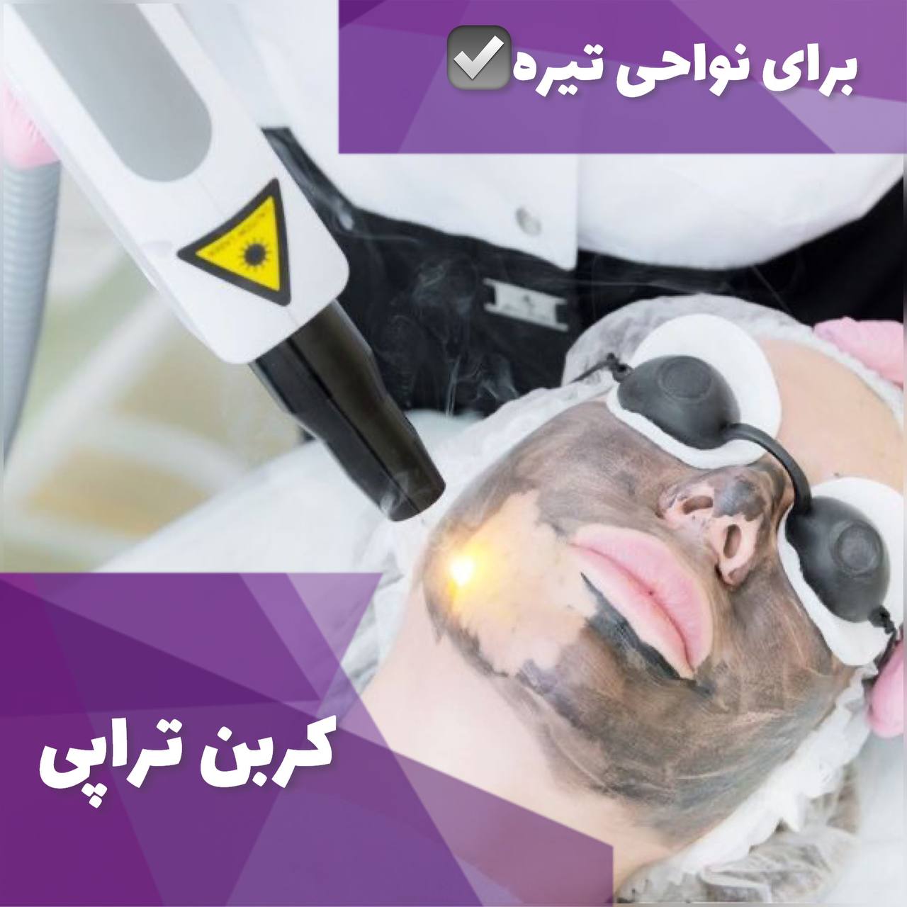 کربن تراپی برای طراوات و شادابی پوست در استان البرز شهر کرج